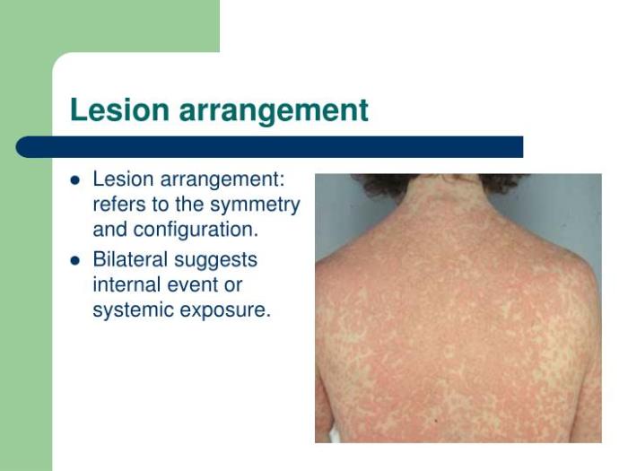 Coalesced type of skin lesion configuration