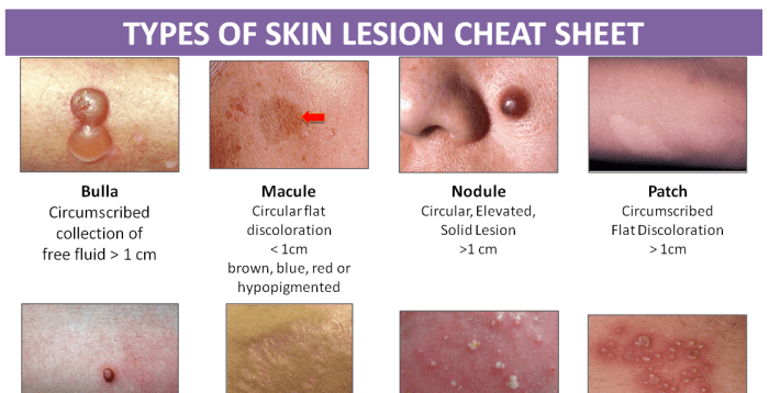 Coalesced type of skin lesion configuration